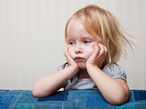 A file photo of a child with chickenpox.