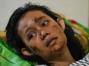 A tsunami survivor with stitches to her face rests at a hospital ward in Kalianda, Lampung province on December 25, 2018, three days after the disaster - caused by activity at a volcano known as the "child" of Krakatoa - hit the west coast of Indonesia's Java island. - Desperately needed aid flowed into a stretch of Indonesia's tsunami-struck coastline on December 25, officials said, but aid workers warned that clean water and medicine supplies were dwindling as thousands crammed makeshift evacuation centres.