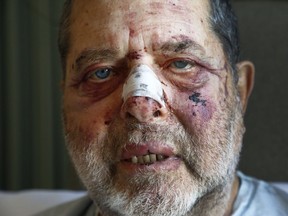 Morty White sits at the Civic Hospital in Ottawa Monday Dec 10, 2018. Morty on Saturday stopped to use an ATM at a bank in Vanier. He was blindsided by a couple of people, possibly in 20s. They didn't take anything. Just left him bloody and battered.