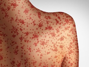 A person in Montreal with a confirmed cases of measles was briefly in Ottawa while the disease was contagious, public health officials warn.