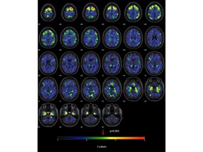 This image provided by The New England Journal of Medicine in April 2019 shows a series brain scans from former NFL players. As a group, they were found to have higher levels of an abnormal protein than a comparison group of healthy men, indicated by red and yellow patches. The protein is a hallmark of a degenerative brain disease that's been linked to repeated head blows.