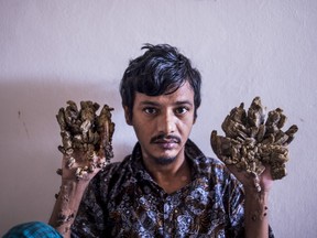 Abul Bajandar , 28, dubbed "Tree Man" for massive bark-like warts on his hands and feet, sits at Dhaka Medical College Hospital in Dhaka on June 24, 2019. - Frustrated by worsening condition, a Bangladeshi father dubbed Tree Man for the bark-like growths on his body said on June 24 he wants to amputate his hands to get relief from "unbearable pain".