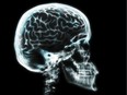 1130 opioids brain -- For Deachman. Getty image brain scan