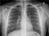 This chest X-ray of a 17-year-old Ontario boy was taken two days after he was hospitalized with a vaping-related lung injury.