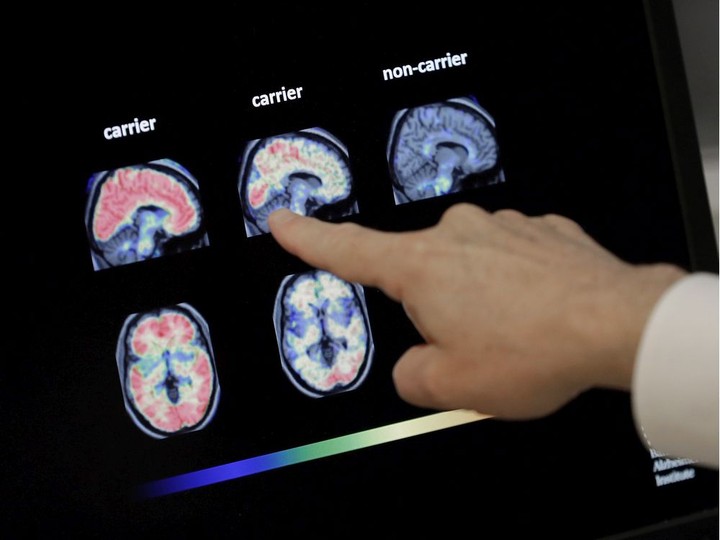  In this Aug. 14, 2018 file photo, Dr. William Burke goes over a PET brain scan at Banner Alzheimers Institute in Phoenix. MATT YORK / THE ASSOCIATED PRESS