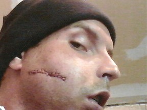 Alex Handforth, a former correctional service officer at Millhaven Institution, shows the scar he received when he was attacked by an inmate on Sept. 21, 2018. (Supplied Photo)