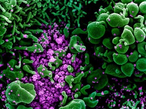 An undated colorized scanning electron micrograph of an apoptotic cell (green) heavily infected with SARS-COV-2 virus particles (purple), also known as novel coronavirus, the virus which causes COVID-19, isolated from a patient sample.   NIAID Integrated Research Facility (IRF)/Handout via REUTERS. THIS IMAGE HAS BEEN SUPPLIED BY A THIRD PARTY. MANDATORY CREDIT ORG XMIT: TOR504