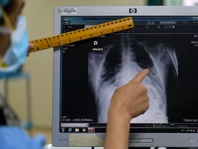 A doctor checks a chest x-ray of a COVID-19 patient at the intensive care unit of Santo Tomas Hospital, in Panama City, on May 6, 2020, amid the new coronavirus pandemic. - Panama accumulated 218 deceased people and nearly 8,000 infections by COVID-19. About a thousand of those infected are in isolation at home or in hotels, 270 are hospitalized on the ground and 88 in the intensive care unit.