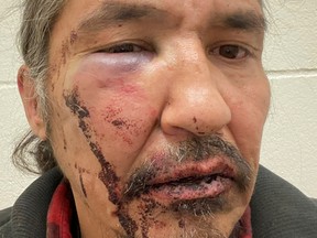 Chief Allan Adam of Athabasca Chipeywan First Nation displays his wounds that he says were caused by Royal Canadian Mounted Police (RCMP) officers of the Wood Buffalo detachment in an incident in Fort McMurray, Alberta, Canada March 10, 2020.