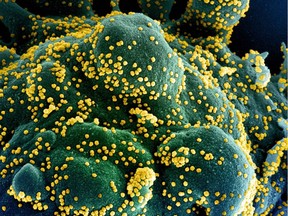 Undated handout image obtained July 15, 2020, shows a colorized scanning electron micrograph of an apoptotic cell (blue/green) heavily infected with SARS-COV-2 virus particles (yellow), isolated from a patient sample, captured at the NIAID Integrated Research Facility (IRF) in Fort Detrick, Maryland.