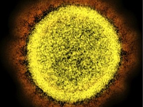 This 2020 electron microscope image made available by the National Institute of Allergy and Infectious Diseases shows a Novel Coronavirus SARS-CoV-2 particle isolated from a patient, in a laboratory in Fort Detrick, Md.