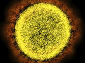 This 2020 electron microscope shows a novel coronavirus SARS-CoV-2 particle isolated from a patient.