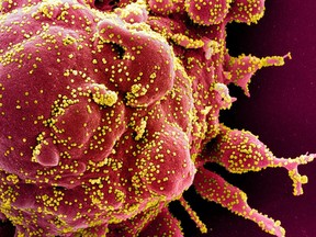 FILE: Colourized scanning electron micrograph of an apoptotic cell (red) infected with SARS-COV-2 virus particles (yellow).