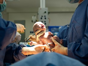 A baby is born via Caesarean Section.