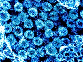 Files: This undated National Institute of Allergy and Infectious Diseases, NIH handout photo obtained August 1, 2021, shows a transmission electron color-enhanced micrograph of SARS-CoV-2 virus particles, isolated from a patient.