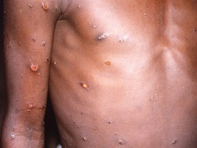 FILES: An image created during an investigation into an outbreak of monkeypox, which took place in the Democratic Republic of the Congo, 1996 to 1997, shows the arms and torso of a patient with skin lesions due to monkeypox, in this undated image obtained by Reuters on May 18, 2022.