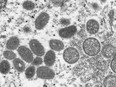 An electron microscopic image shows mature, oval-shaped monkeypox virus particles as well as crescents and spherical particles of immature virions, obtained from a clinical human skin sample associated with the 2003 prairie dog outbreak.