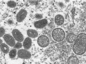 This 2003 electron microscope image provided by the Centers for Disease Control and Prevention shows oval-shaped mature monkeypox virions, left, and spherical immature virions, right, obtained from a human skin sample. associated with the 2003 prairie dog outbreak.