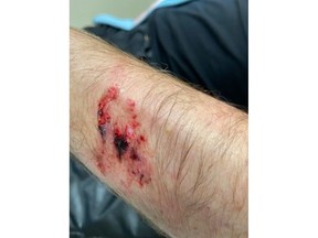 A close-up shows the bite on Robert Pagé's left arm, where you can see the outline of the dog's teeth.