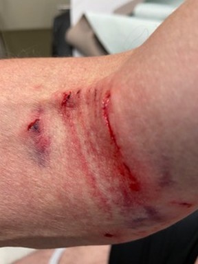 A close up shows the bite to Bruce McConville’s arm where you can see the outline of the dog’s jaw.