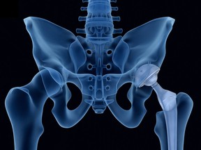Life-altering procedures such as hip replacements are being delayed again and again. Whatever their future 'plans,' politicians and policymakers are far from resolving the backlog.