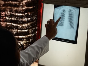 A doctor checks the chest X-ray of a patient in the tuberculosis (TB) department of a hospital in Hyderabad, India. COVID-19 has directed some resources away from tuberculosis-related care, which has had devastating impacts on populations at risk.