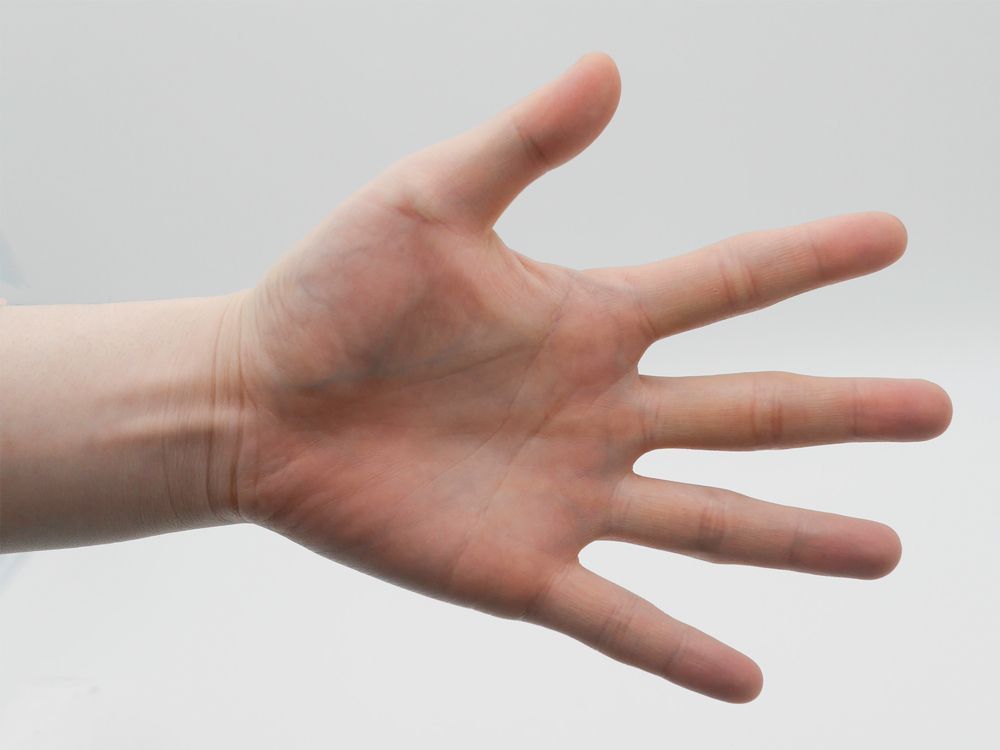 For the 20-year-old patient, the amputation of two fingers &ldquo;proved to be a highly satisfying curative treatment,&rdquo; according to a case report.