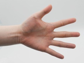 For the 20-year-old patient, the amputation of two fingers “proved to be a highly satisfying curative treatment,” according to a case report.