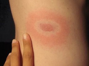 Erythematous rash in the pattern of a "bull's-eye" from Lyme disease.