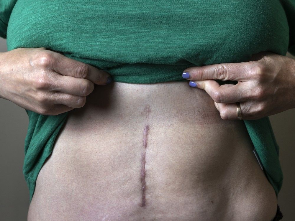  Helene Goldberg shows her stomach after anonymously donating part of her liver.