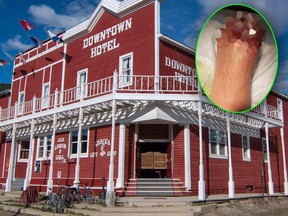 Nick Griffiths lost three toes to frostbite in a Yukon sled race. He can't think of a better place for them to go than into people's drinks. He plans to donate his amputated appendages to the Downtown Hotel in Dawson City, Yukon, home of the famed Sourtoe Cocktail. (THE CANADIAN PRESS/HO - Nick Griffiths/Dawson Hotel/Facebook)