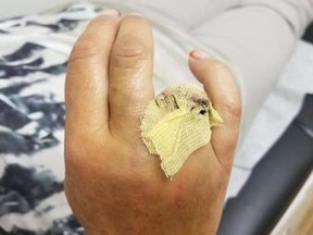 Claire Clark's hand is shown after an amputation following an accident at the West Edmonton Mall waterslide in this recent handout photo.