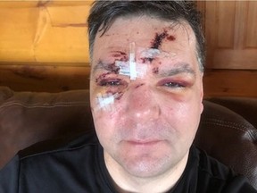 Martin Burger of Cobden suffered facial lacerations after a chunk of ice flew off a car going in the opposite direction on Highway 17 west of Renfrew on Jan. 16, 2020. The chunk of ice shattered the glass and opened a hole in the windshield. Burger is asking the public to spend a few more minutes clearing ice off their vehicles.