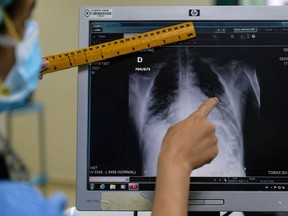 FILE: A doctor checks a chest x-ray of a COVID-19 patient.