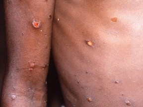 An image created during an investigation into an outbreak of monkeypox, which took place in the Democratic Republic of the Congo, from 1996 to 1997, shows the arms and torso of a patient with skin lesions due to monkeypox, in this undated image obtained by Reuters on May 18, 2022.