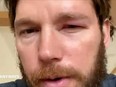 Chris Pratt shows off his bee sting.