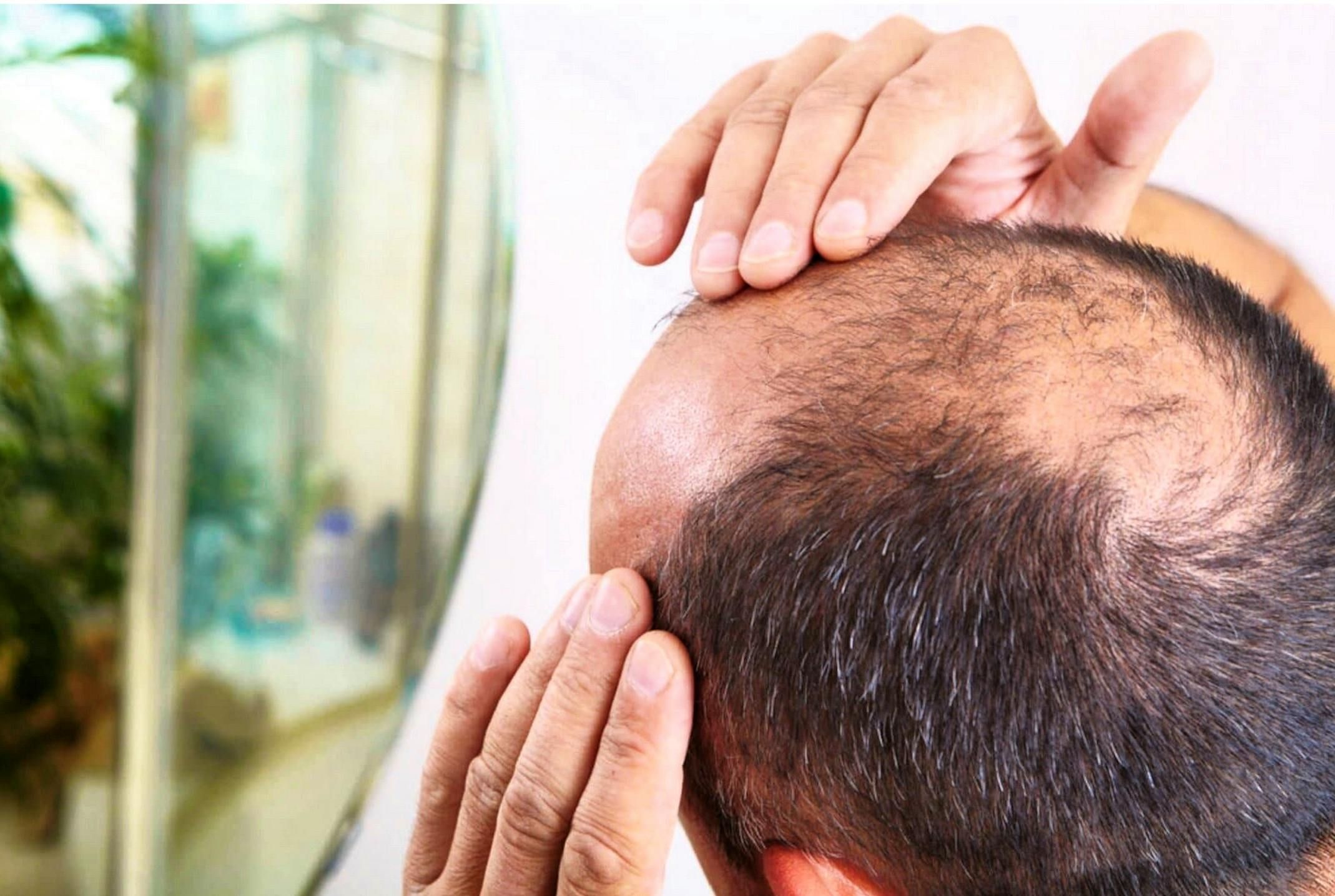 Going bald is a style choice: When you first start to notice the signs ...