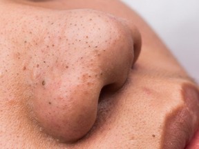 Blackheads are open hair follicles that are clogged with bacteria, oil and dead skin cells.