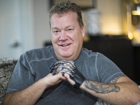 FILE: Erik Bjarnason, at home in North Vancouver, wearing his new prosthetic hand.