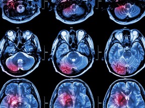 Image for representation. Compared to those who screened negative for THC, recent weed users did not have significantly larger aneurysms, worse stroke symptoms, higher blood pressure or more cardiovascular risk factors when admitted to the hospital. /