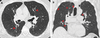 Airway changes in a 66-year-old male marijuana and tobacco smoker. Contrast-enhanced (A) axial and (B) coronal CT images show cylindrical bronchiectasis and bronchial wall thickening (arrowheads) in multiple lung lobes bilaterally in a background of paraseptal (arrows) and centrilobular emphysema. /