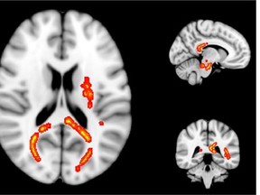 Areas of significantly reduced myelin in athletes with concussion two weeks after an injury.     — UBC MRI Research Centre