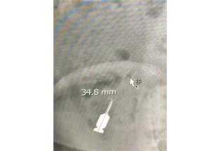 Istvan Balyi is suing his dentist after he had to have doctors at Vancouver General Hospital remove a dental drill bit that he alleges was negligently dropped into his throat and that he swallowed.