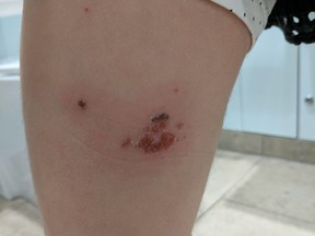 Bedbug bites are seen on Molly Reid's thigh in this undated handout photo.