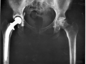 An X-ray of a pelvis showing a total hip joint replacement. The B.C. government has committed millions to shortening wait times for hip and knee replacement surgeries in the province.