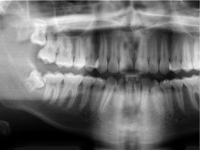 Photo of a basic panoramic radiograph showing impacted wisdom teeth in a 16-year-old.