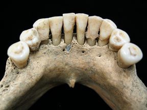 The dental calculus on the lower jaw where a medieval woman entrapped lapis lazuli pigment, seen below centre tooth. The find corroborates other findings that suggest female artisans in that time period were not as rare as previously thought.