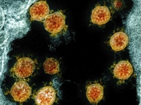 This electron microscope image shows Novel Coronavirus SARS-CoV-2 virus particles, orange, isolated from a patient.