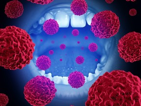 A mouth with malignant disease cells illustrating oral cancer.