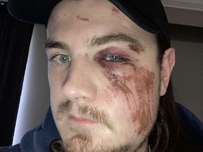Patrick Belanger shows injuries sustained during a trip to British Columbia. Belanger of Quebec City says he was denied surgery for a week after he fell and broke his jaw and cheekbone and ended up in the emergency room of a hospital in B.C., where a surgeon told him he couldn't do the operation because Quebec "doesn't pay."